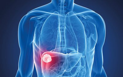 Karaciğer Kanseri Belirtileri Nelerdir, Nasıl Tanı Konur ve Tedavi Edilir?